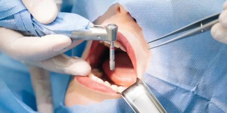 Trụ Implant Biotem: Lựa chọn kinh tế hay chất lượng?